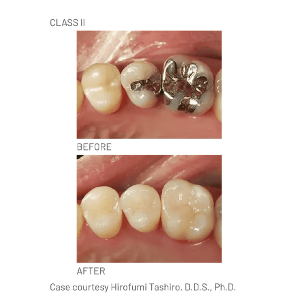 Resina Composite Palfique LX5 Tokuyama